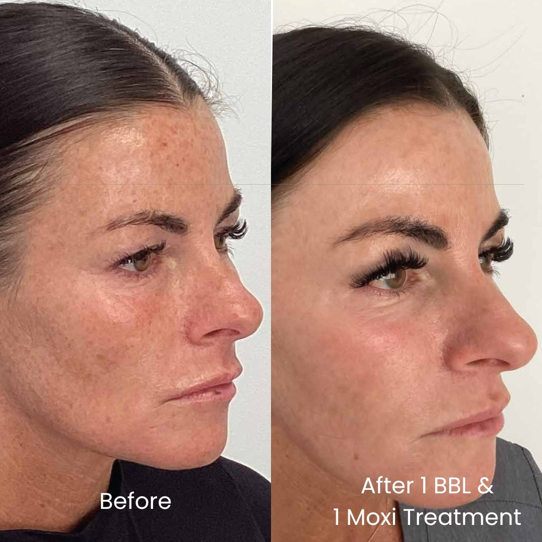 Moxi & BBL Combo-Face