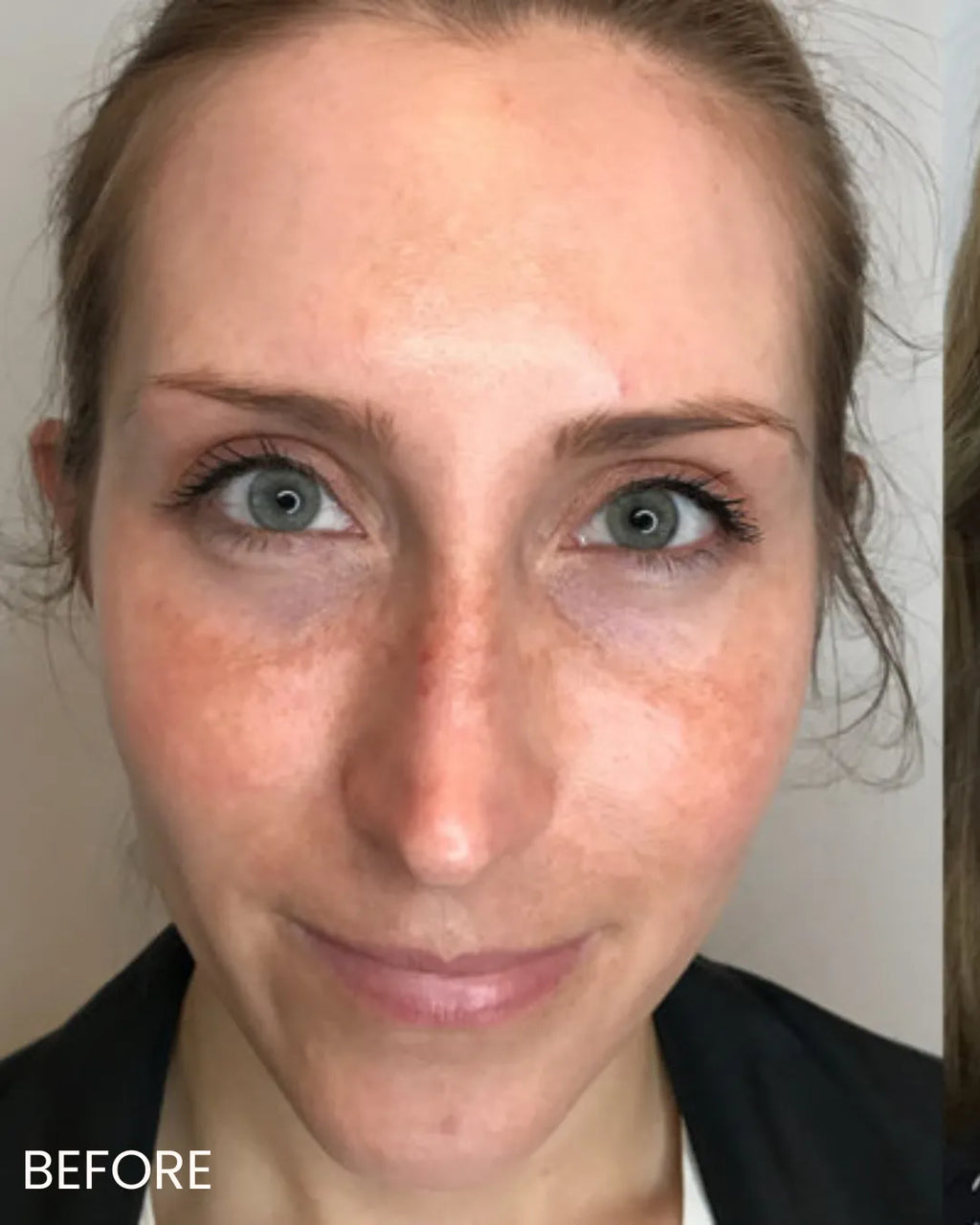 BBL Laser for Face - <b>New Client Special</b>