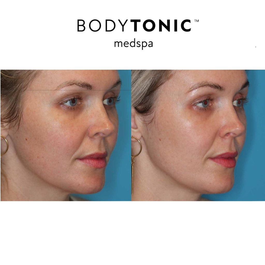 Moxi & BBL Combo-Face