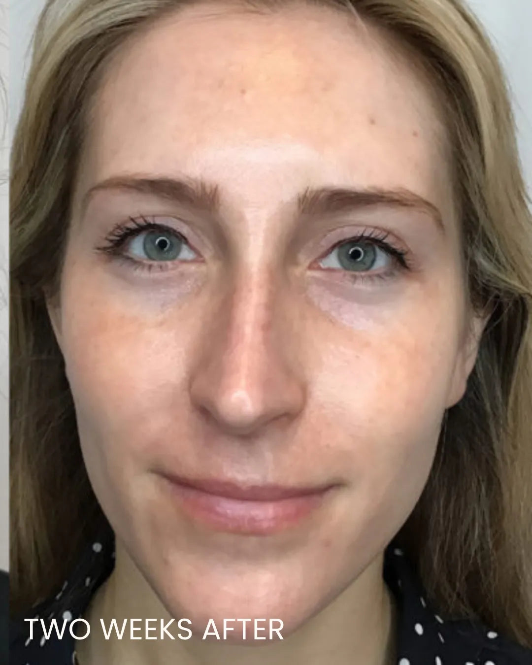 BBL Laser for Face - <b>New Client Special</b>