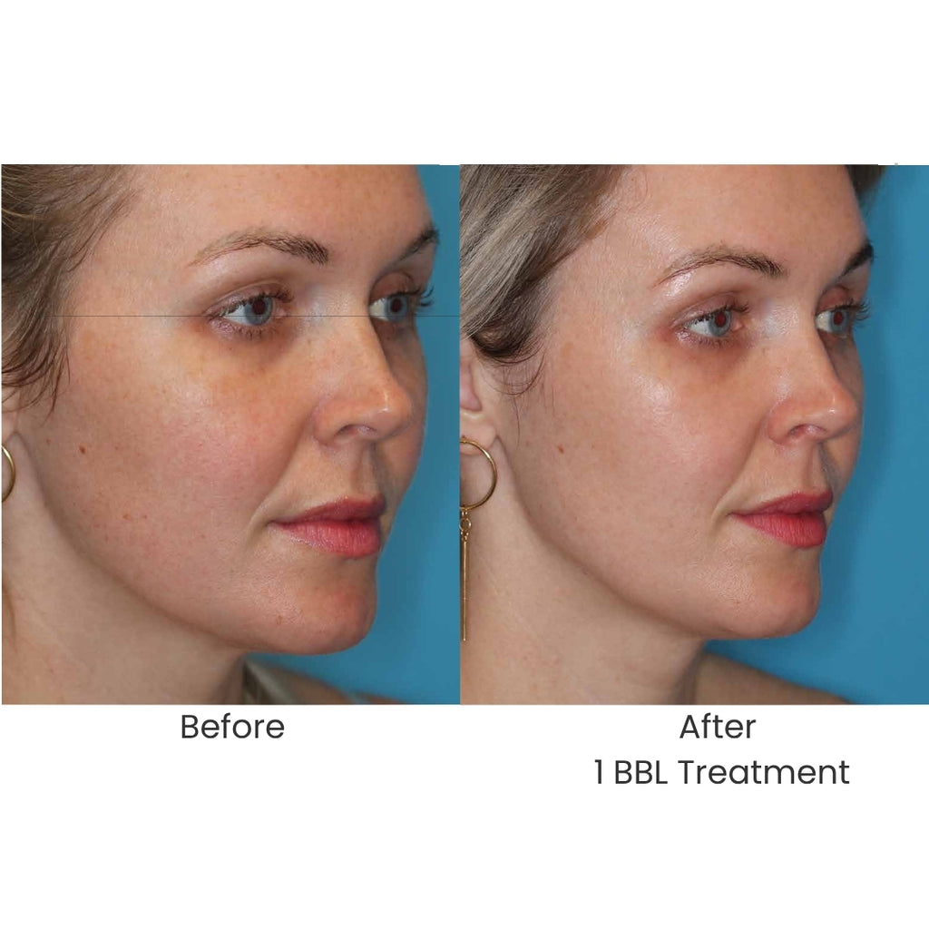 BBL Laser for Face - <b>New Client Special</b>