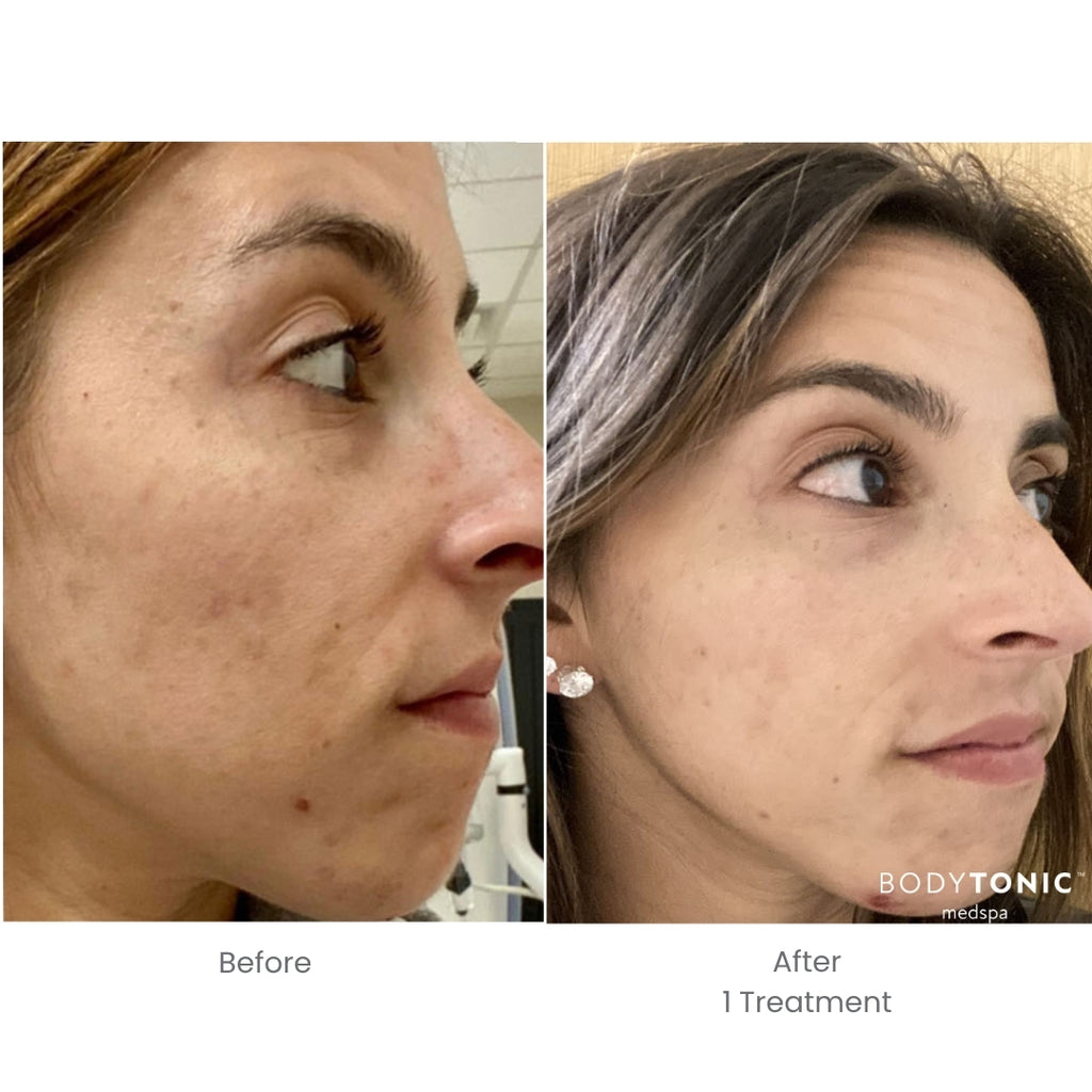 BBL Laser for Face - <b>New Client Special</b>