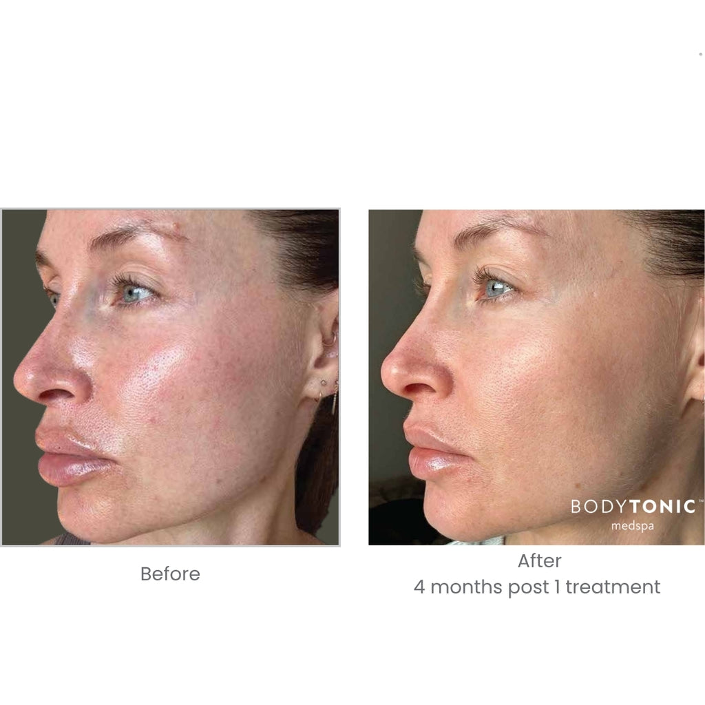 BBL Laser for Face - <b>New Client Special</b>