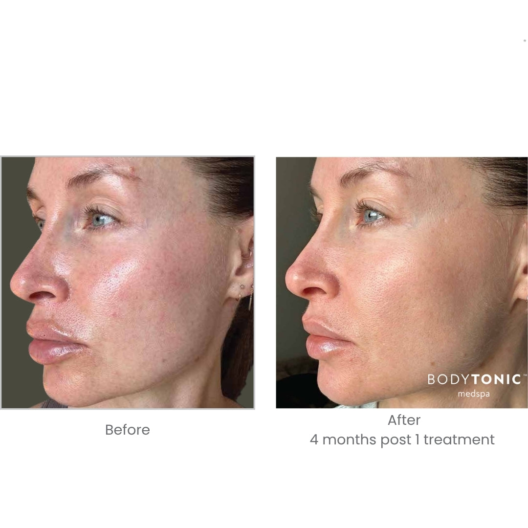 BBL Laser for Face - <b>New Client Special</b>