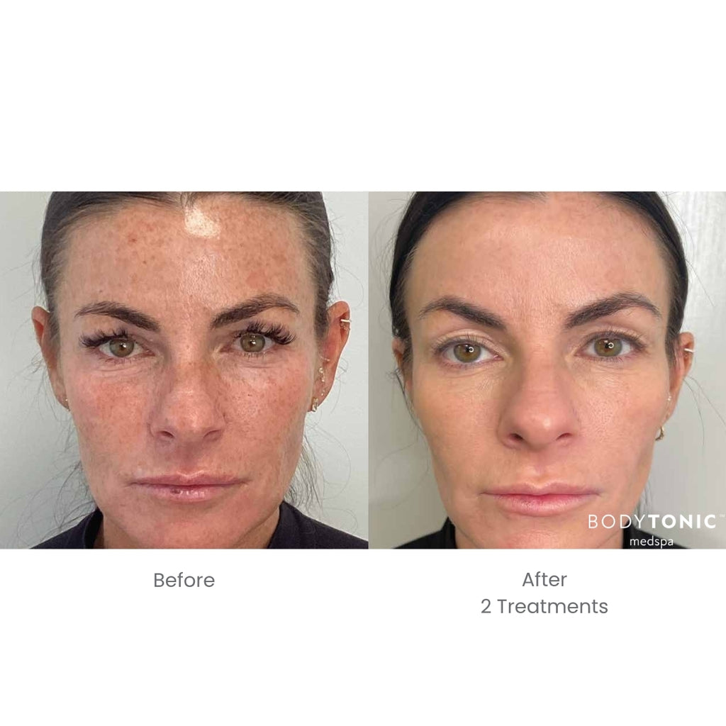 BBL Laser for Face - <b>New Client Special</b>