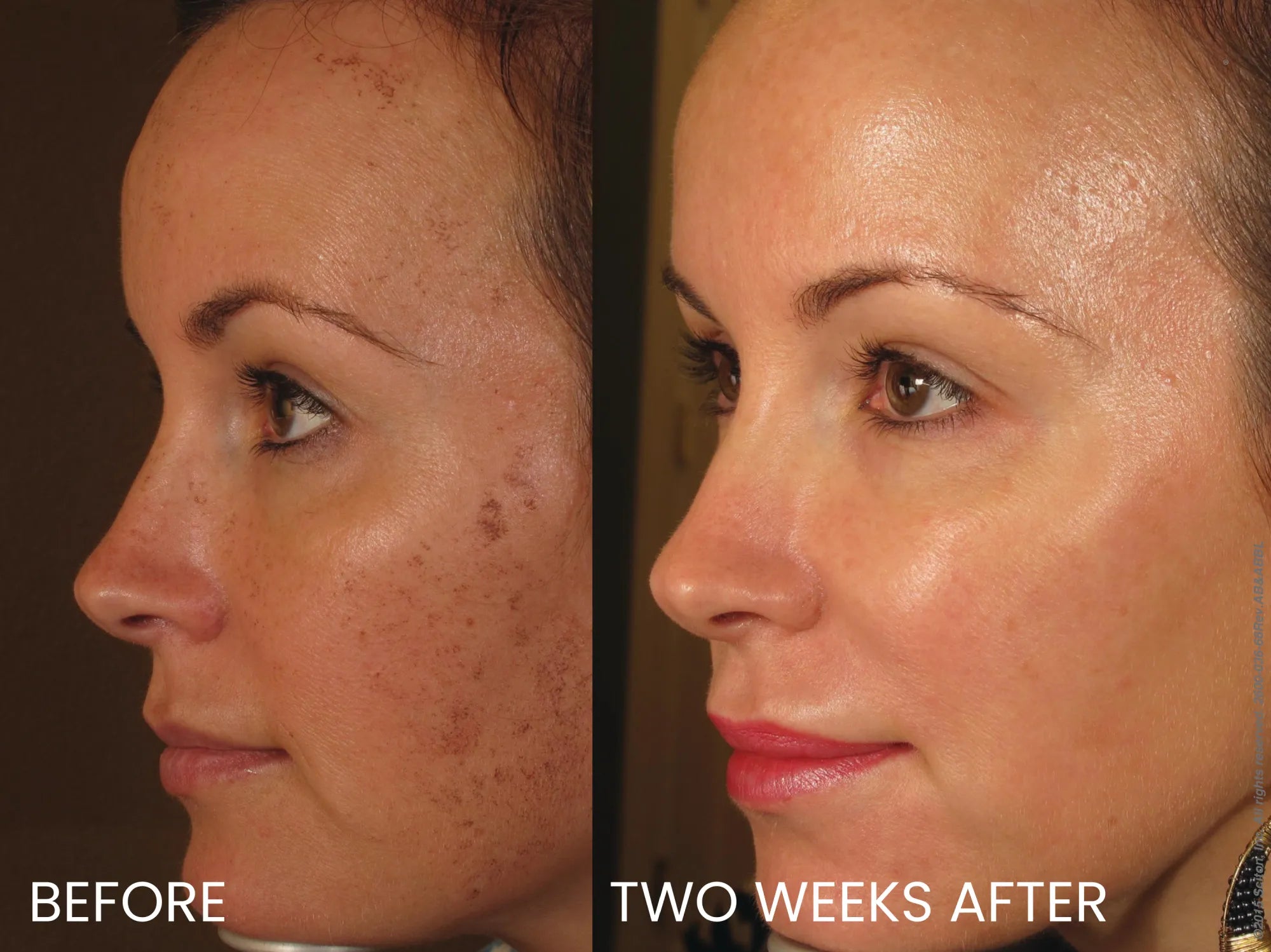 BBL Laser for Face - <b>New Client Special</b>