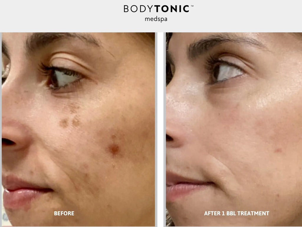 BBL Laser for Face - <b>New Client Special</b>