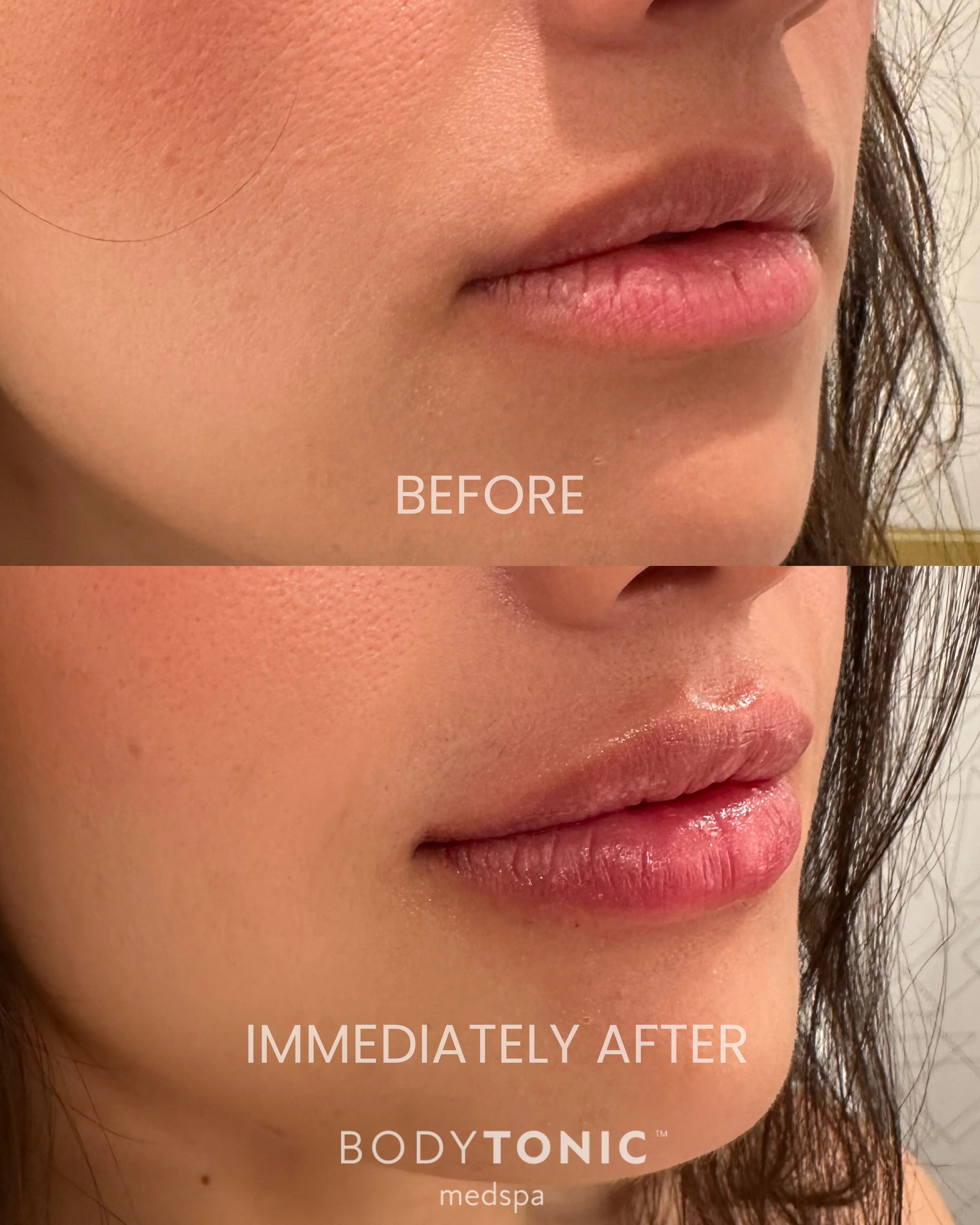 Lip Filler