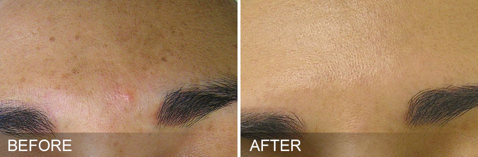 Pre-Event Glow-Up - HydraFacial +Dermaplane +LED Mask