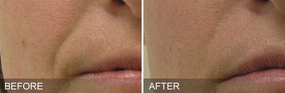 Pre-Event Glow-Up - HydraFacial +Dermaplane +LED Mask