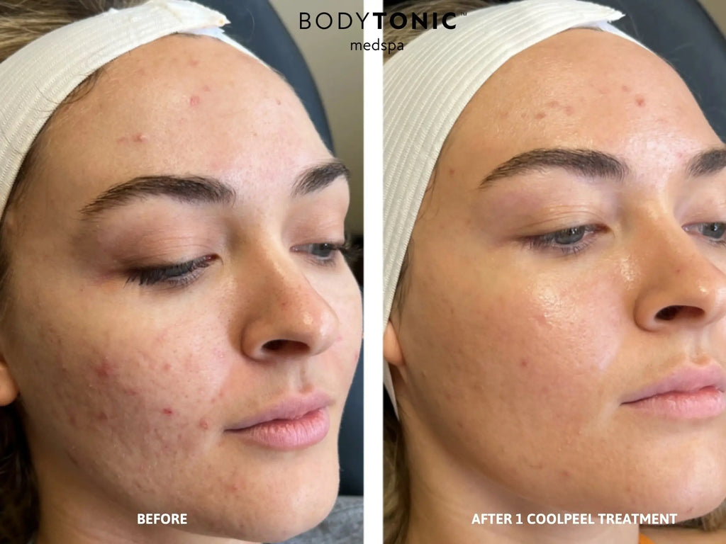 VirtueRF Microneedling + CO2 CoolPeel Laser - <b>Transformation Bundle</b>