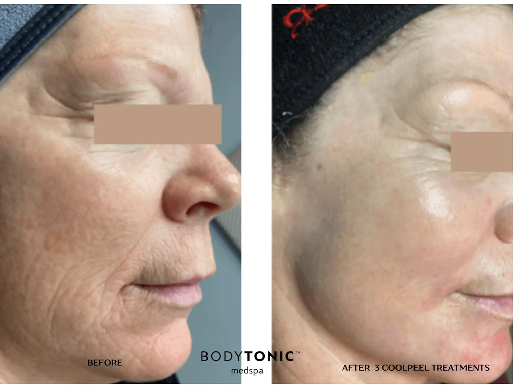 VirtueRF Microneedling + CO2 CoolPeel Laser - <b>Transformation Bundle</b>
