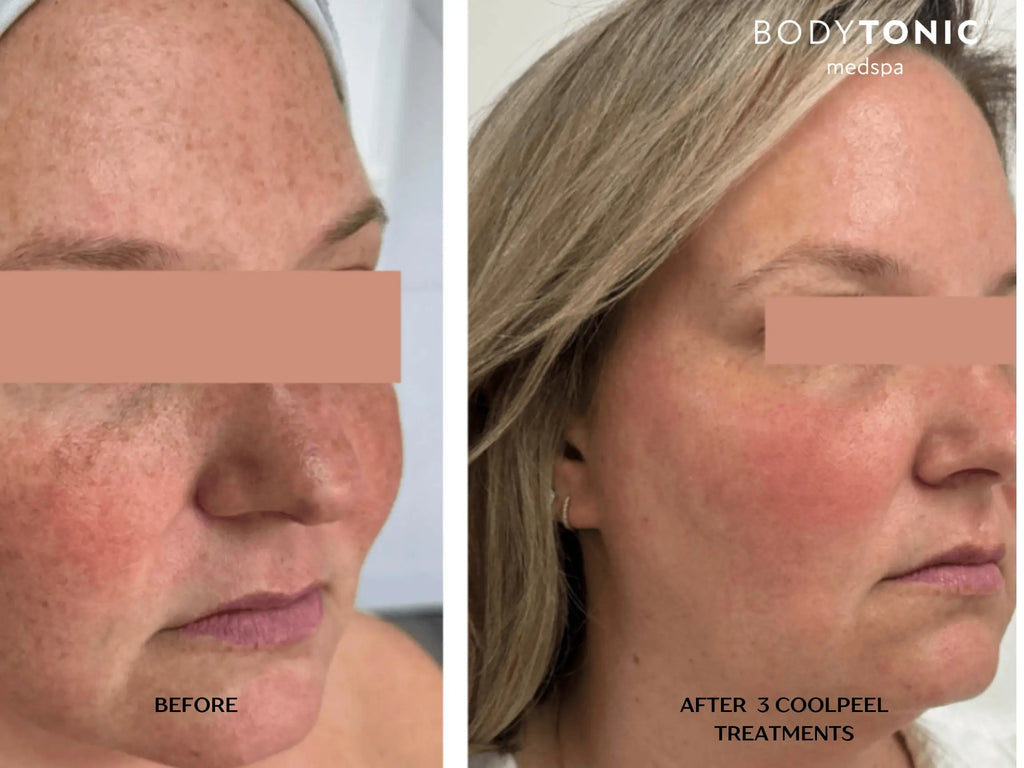 VirtueRF Microneedling + CO2 CoolPeel Laser - <b>Transformation Bundle</b>