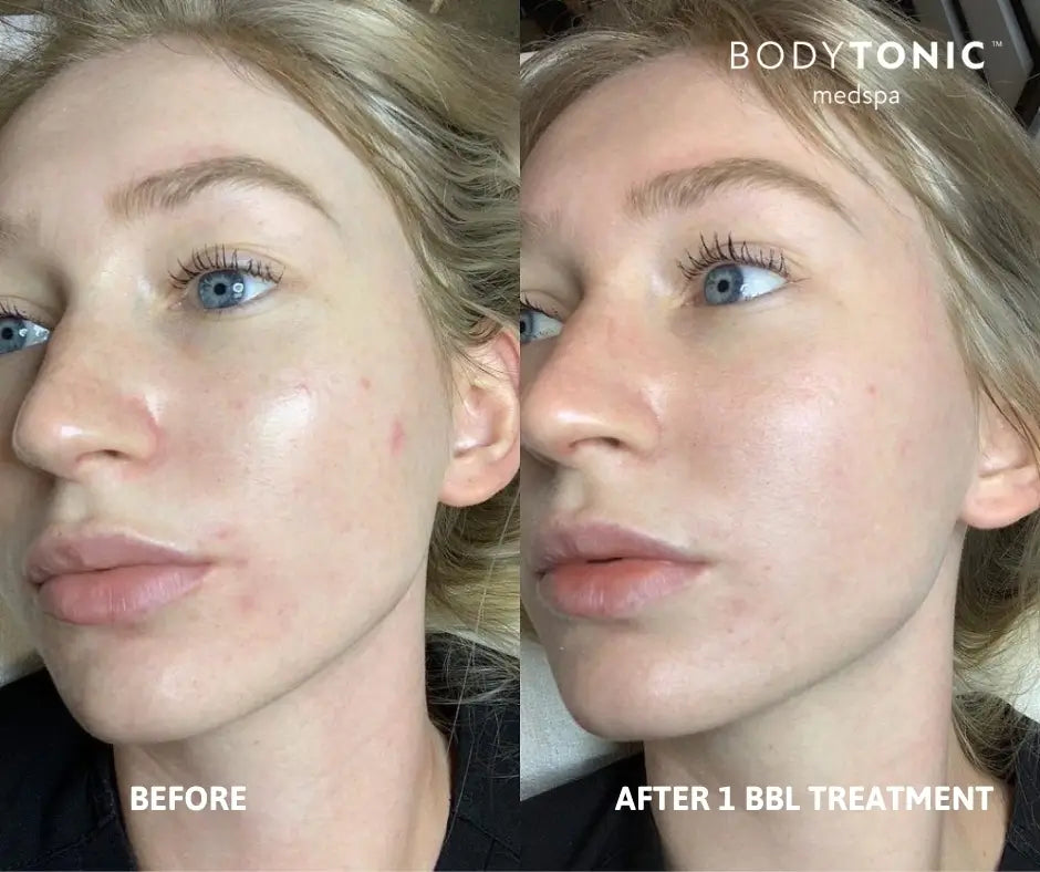 BBL Laser for Face - <b>New Client Special</b>