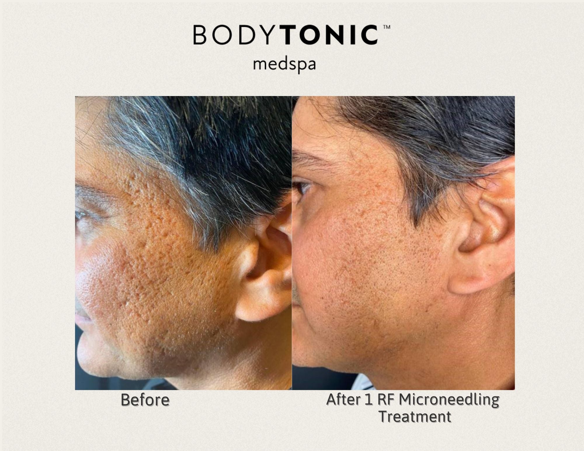 Virtue RF Microneedling (Face & Neck)