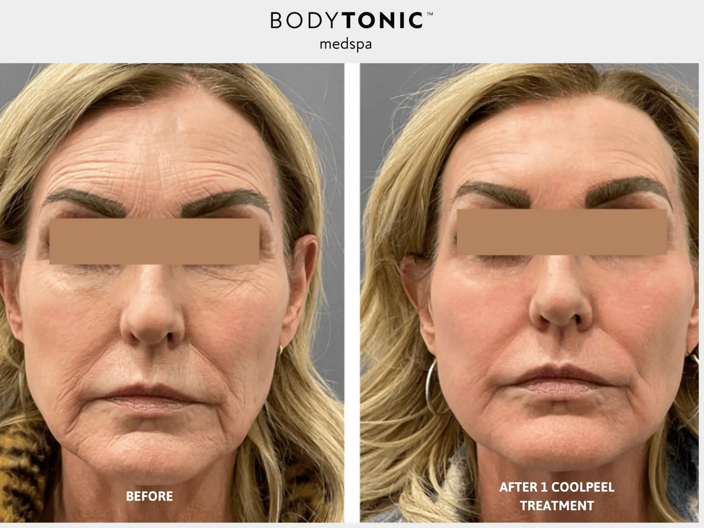 VirtueRF Microneedling + CO2 CoolPeel Laser - <b>Transformation Bundle</b>