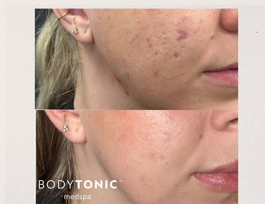 Virtue RF Microneedling (Face & Neck)
