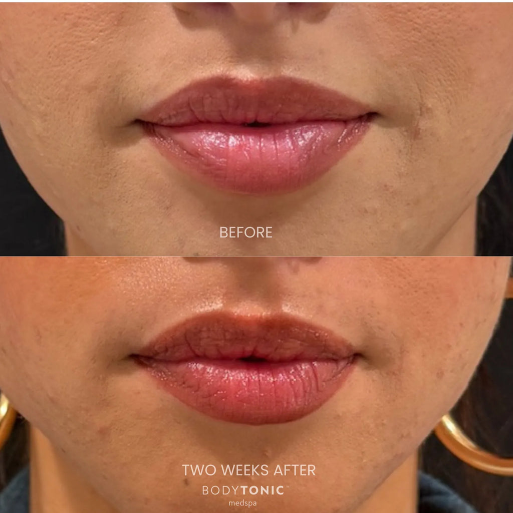 Lip Filler