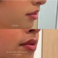 Lip Flip - <b>Subtle Lift & Refined Contour</b>