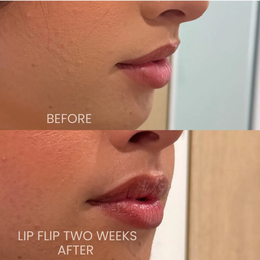 Lip Filler