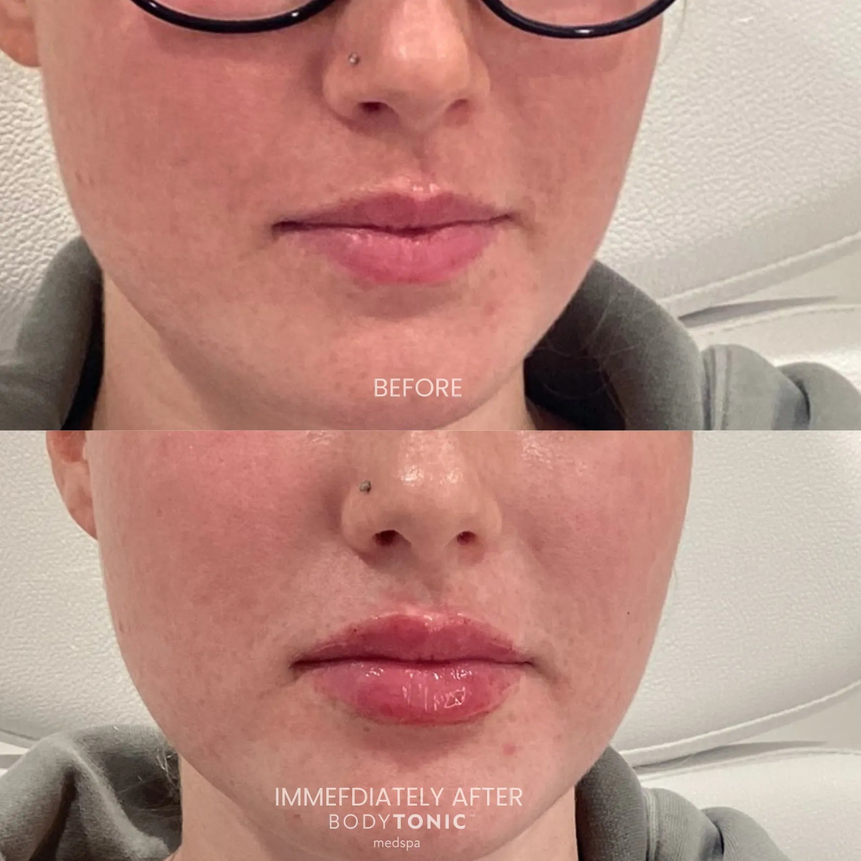 Lip Filler