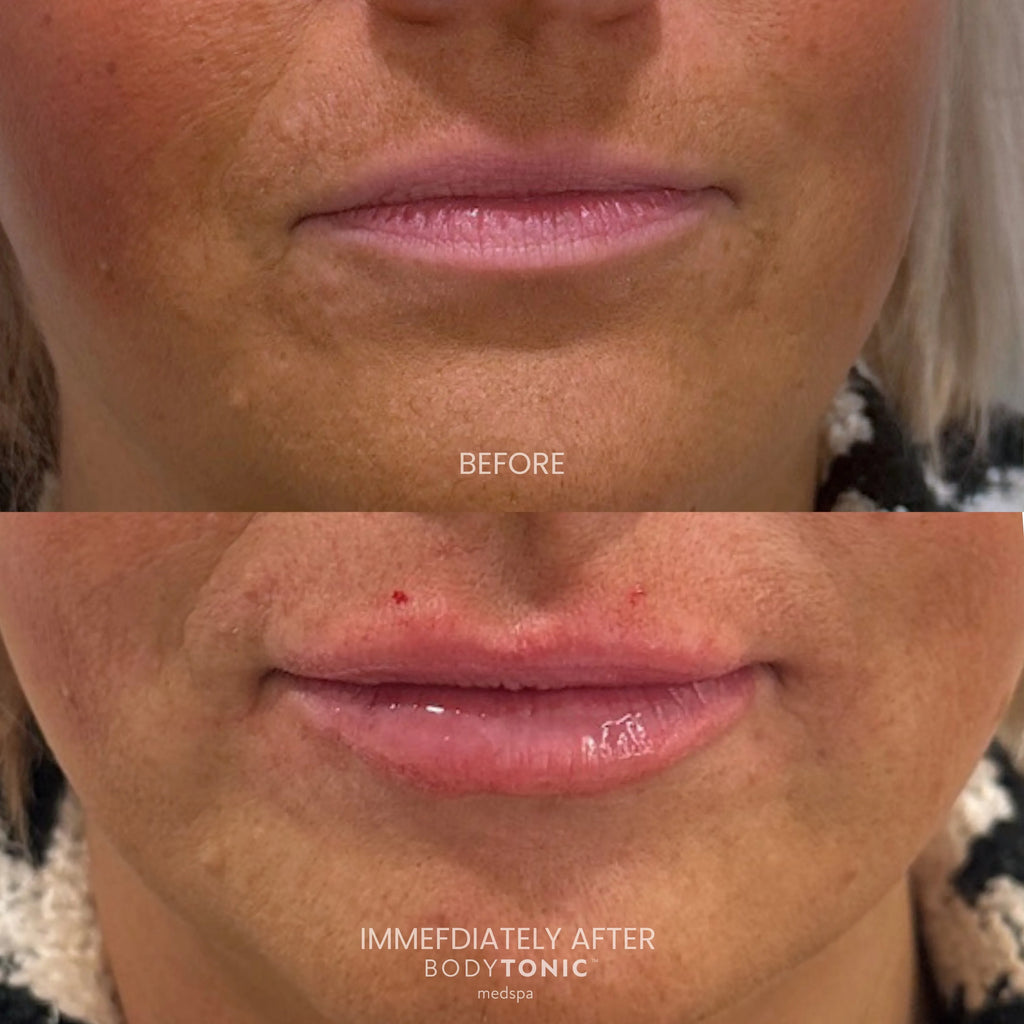 Lip Flip - <b>Subtle Lift & Refined Contour</b>