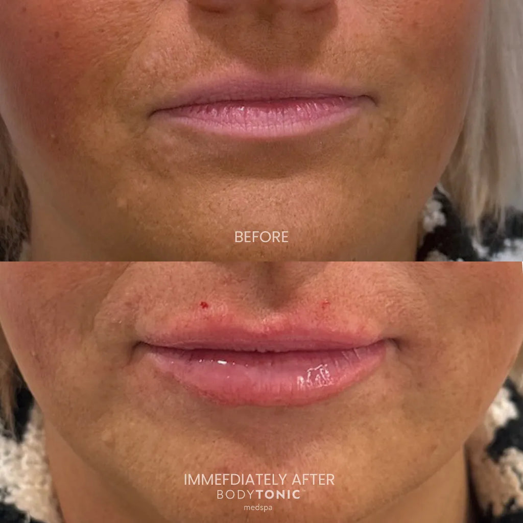 Lip Filler