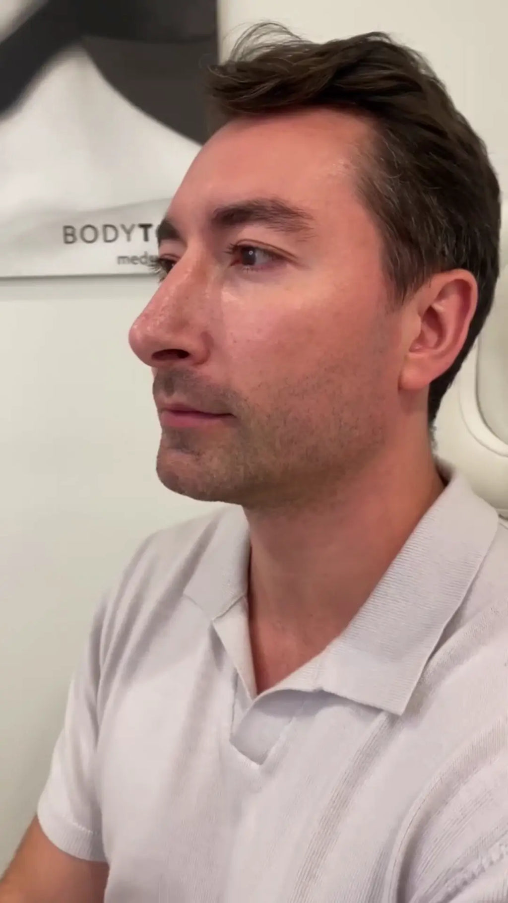 Hair Loss Treatment- Microneedling with Exosomes