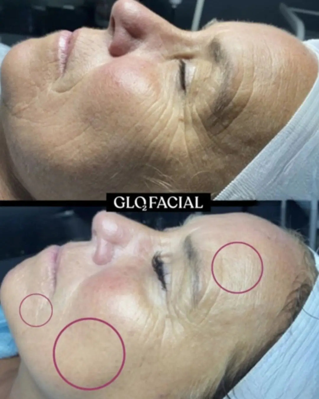 Glo2Facial - <b>Radiance Boost Treatment</b>