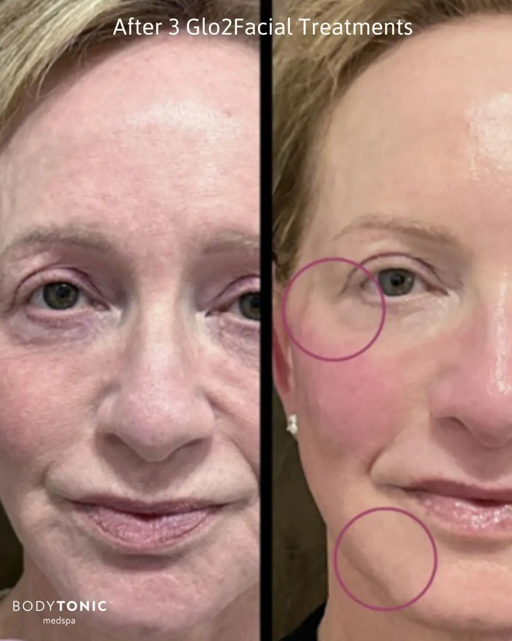 Glo2Facial - <b>Radiance Boost Treatment</b>