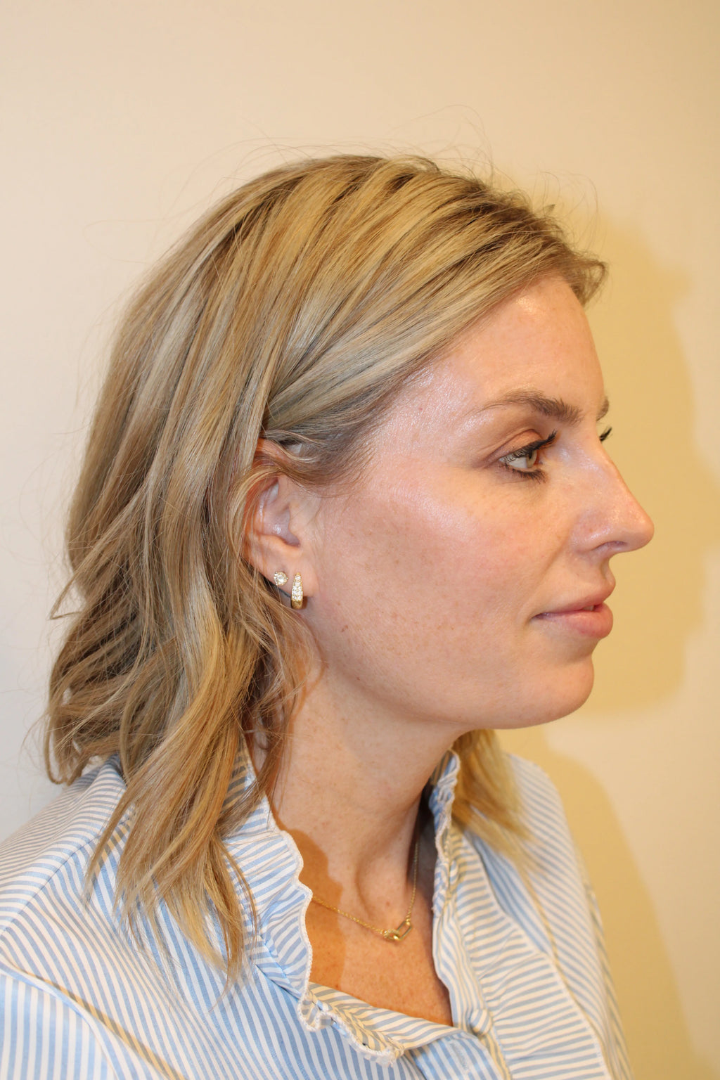 BBL Laser for Face - <b>New Client Special</b>