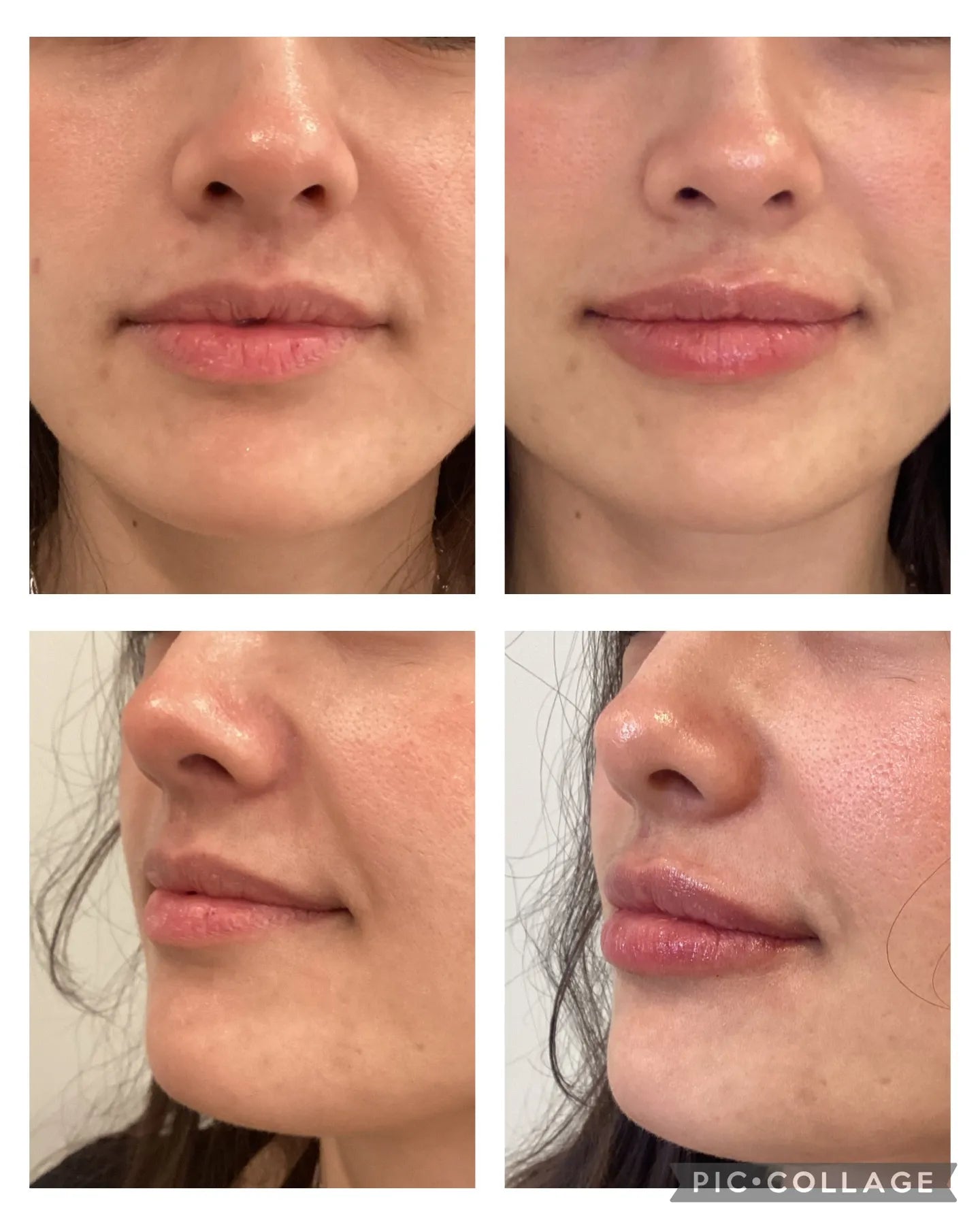 Lip Filler