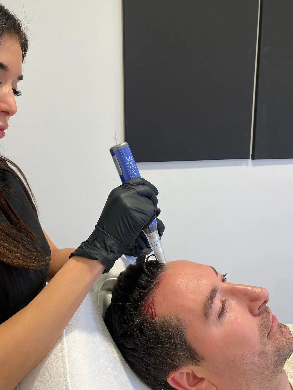 Hair Loss Treatment- Microneedling with Exosomes