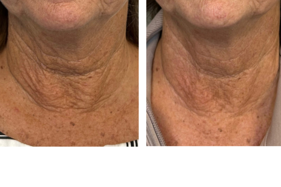 Before and after comparison of neck skin treatment with Virtue RF + Coolpeel, showing three sessions' results.