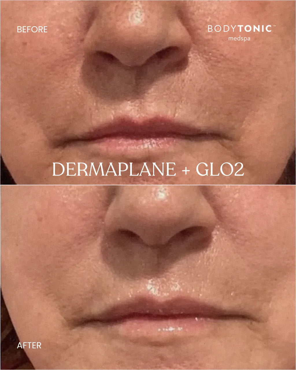 Glo2Facial - <b>Radiance Boost Treatment</b>