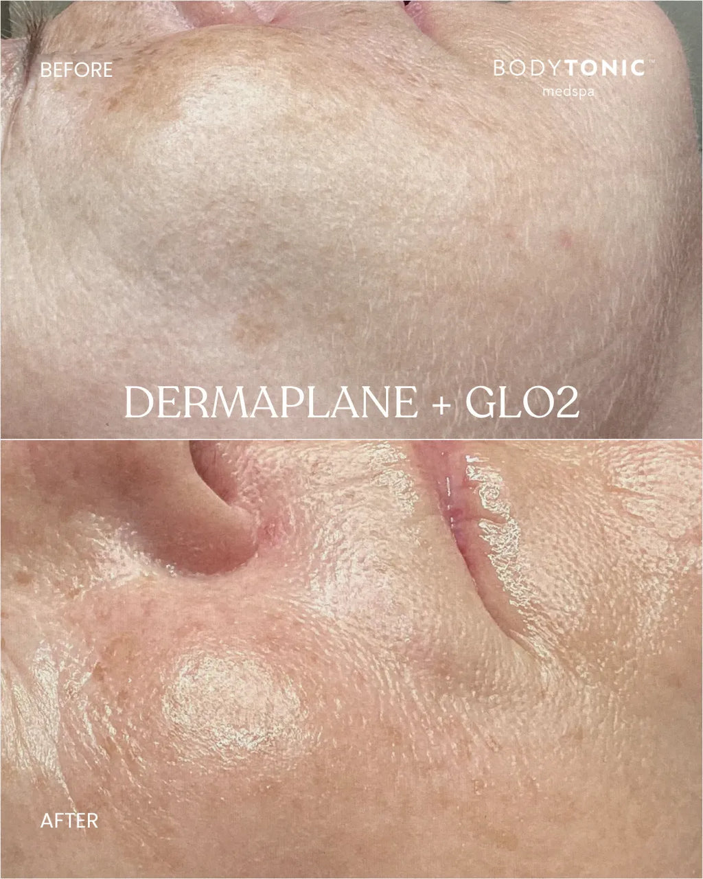 Glo2Facial - <b>Radiance Boost Treatment</b>