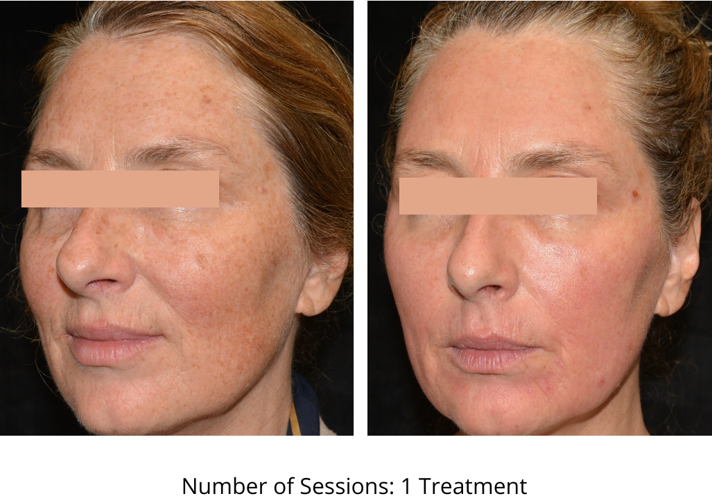 CO₂ Laser CoolPeel (Face & Neck)