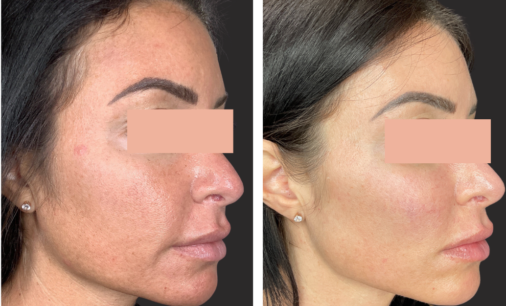 CO₂ Laser CoolPeel (Face & Neck)