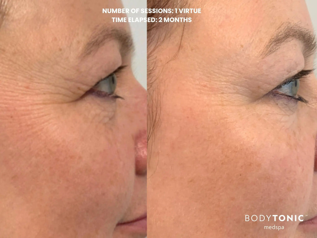 VirtueRF Microneedling + CO2 CoolPeel Laser - <b>Transformation Bundle</b>