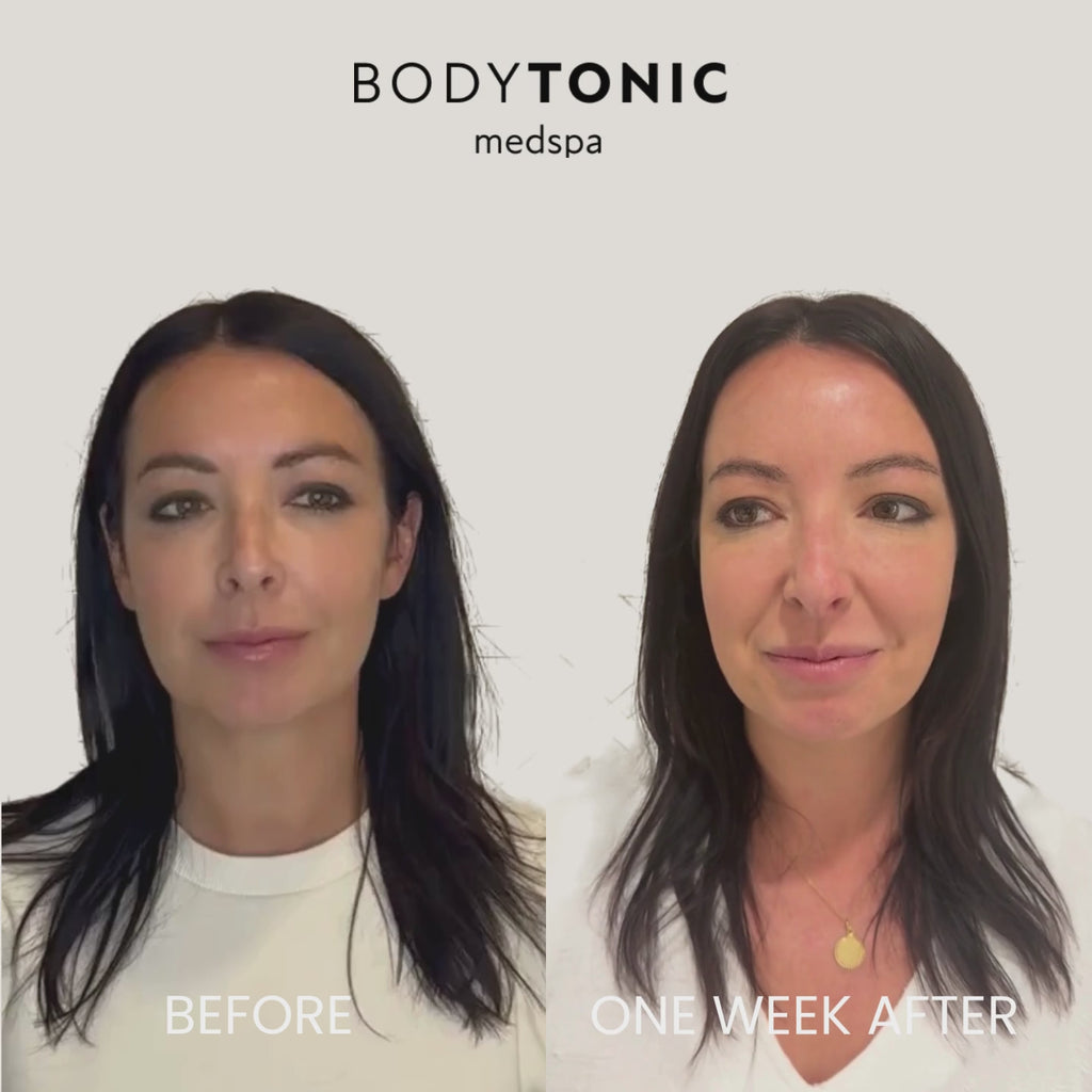 Forehead Tox - <b>New Client Special</b>