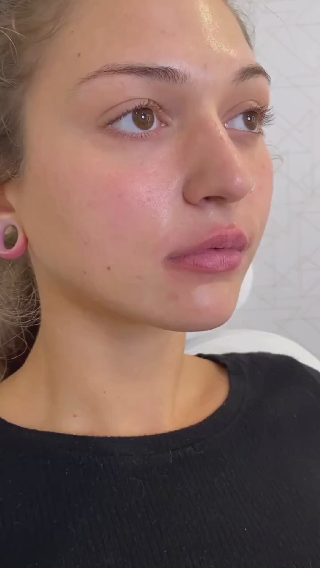 Lip Filler