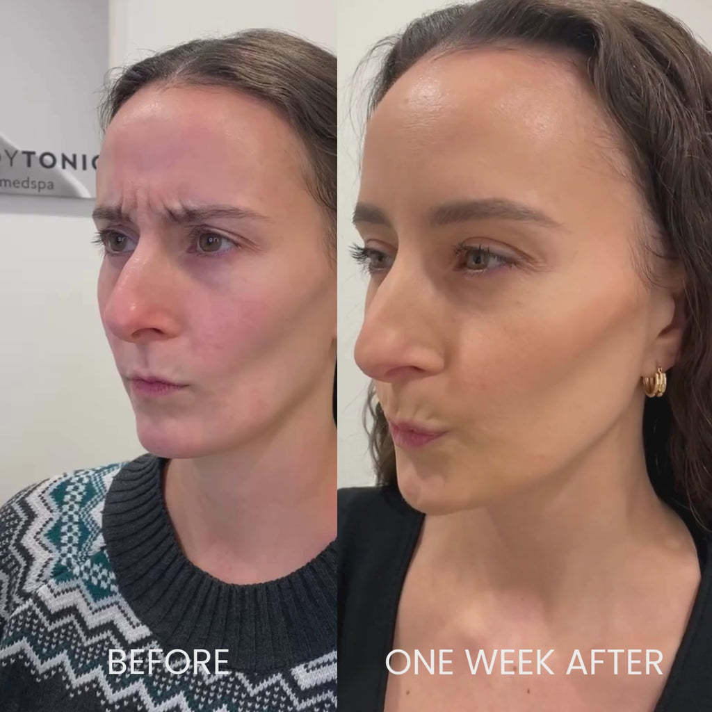 Forehead Tox - <b>New Client Special</b>