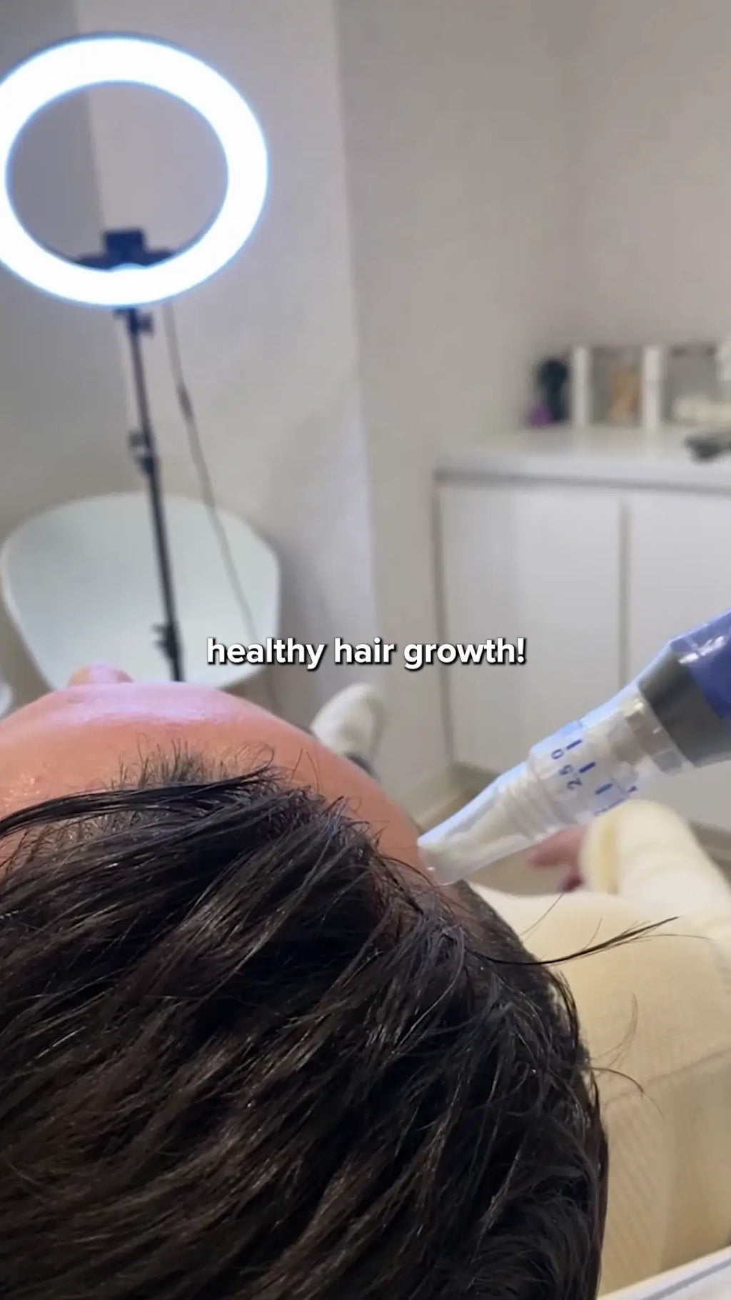 Hair Loss Treatment- Microneedling with Exosomes