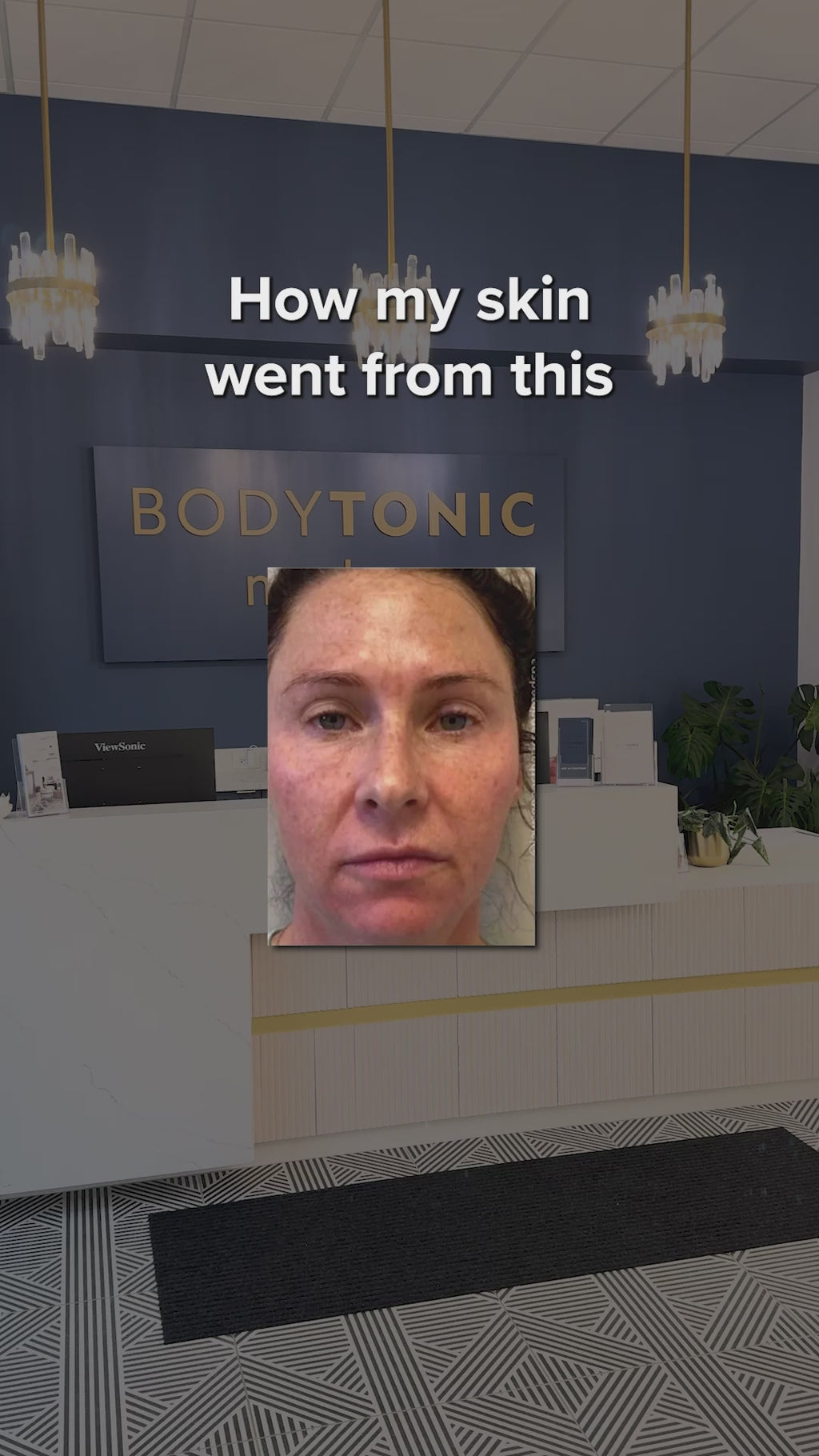 VirtueRF Microneedling + CO2 CoolPeel Laser - <b>Transformation Bundle</b>