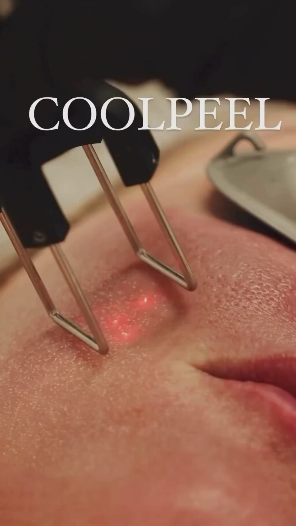 VirtueRF Microneedling + CO2 CoolPeel Laser - <b>Transformation Bundle</b>