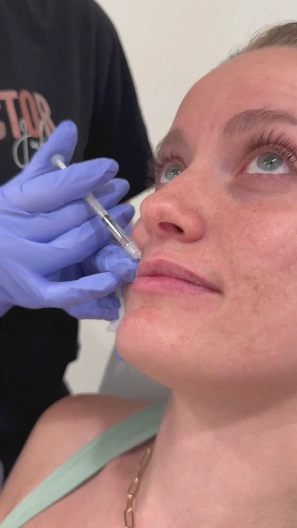 Lip Flip - <b>Subtle Lift & Refined Contour</b>